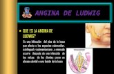 Angina de Ludwig Por: Corina Arias A.