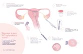 Infografia nº3 20 06 18...2. 2.1 6. 1. 5. 3. 4. Wanneer is een IVF behandeling zinvol? ·Vrouwen onder de 38 jaar ·Lage ovariële reserve ·Endometriose ·Polycystieke eierstokken
